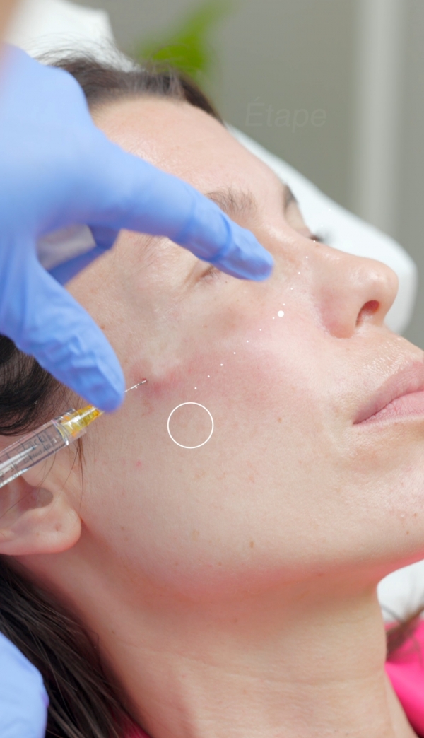 J'ai testé les injections d'Acide Hyaluronique et de toxine botulique chez Regeneva, mon avis!